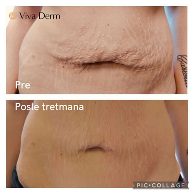 Viva Derm - pre i posle (1)