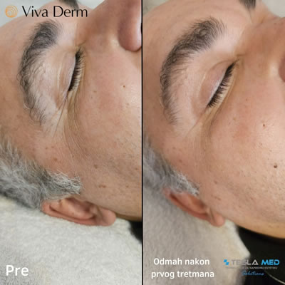 Viva Derm - pre i posle (2)