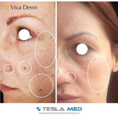 Viva Derm - pre i posle (4)