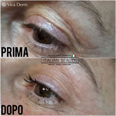 Viva Derm - pre i posle (5)