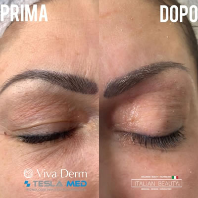 Viva Derm - pre i posle (6)